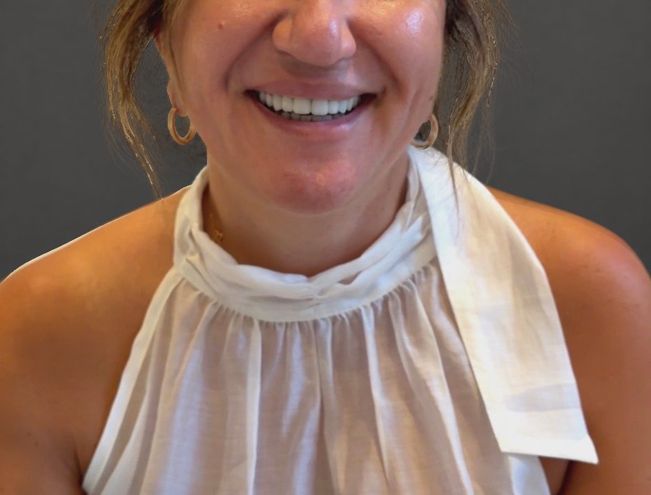 Neck Lift After - Patient 506656 - Image 2