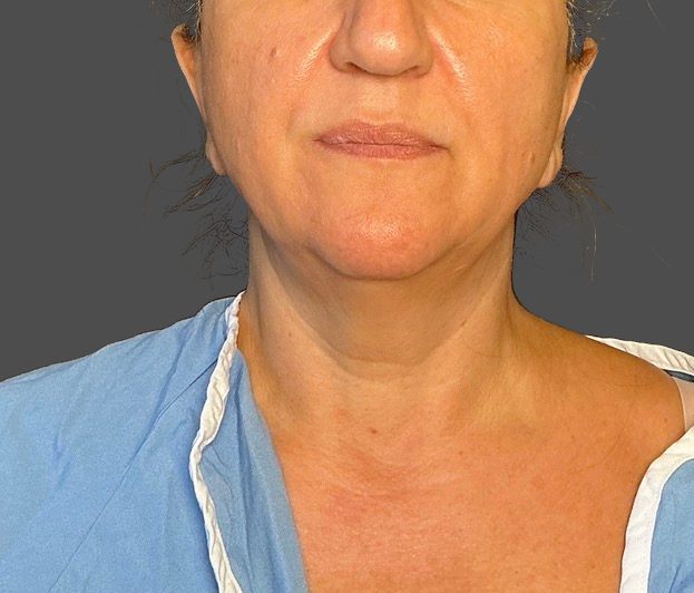 Neck Lift Before - Patient 506656 - Image 1