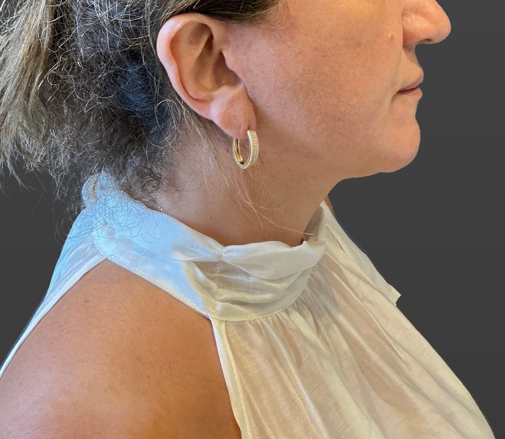 Neck Lift After - Patient 506656 - Image 4