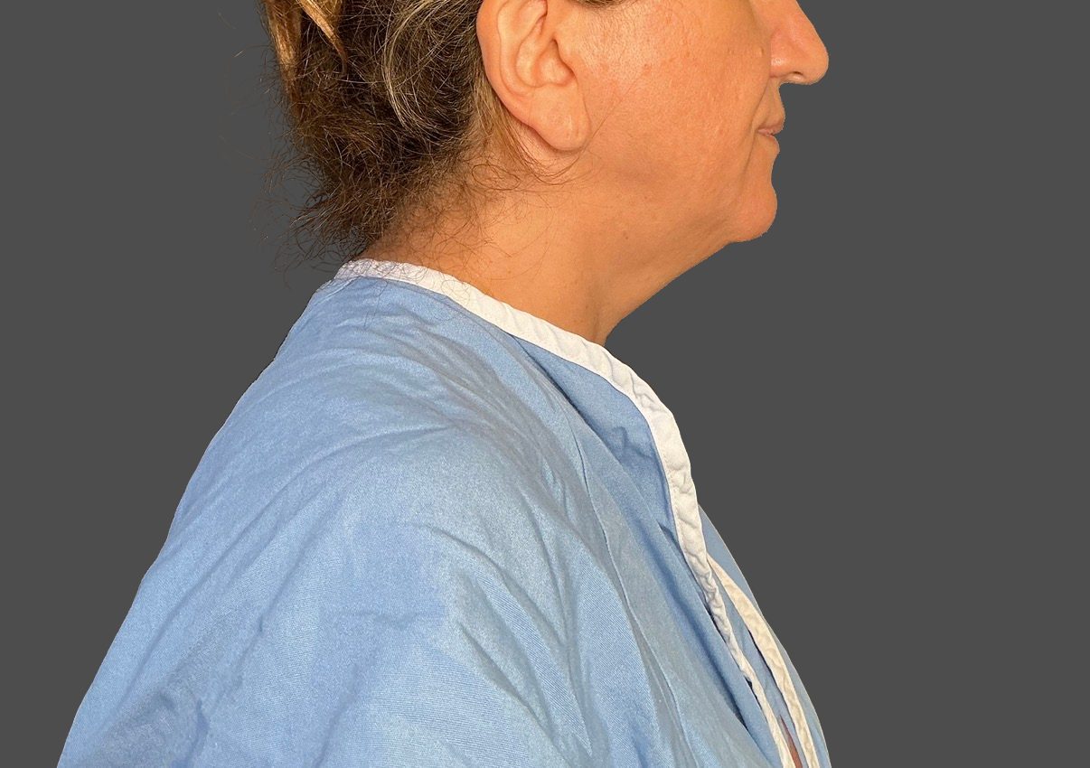 Neck Lift Before - Patient 506656 - Image 3