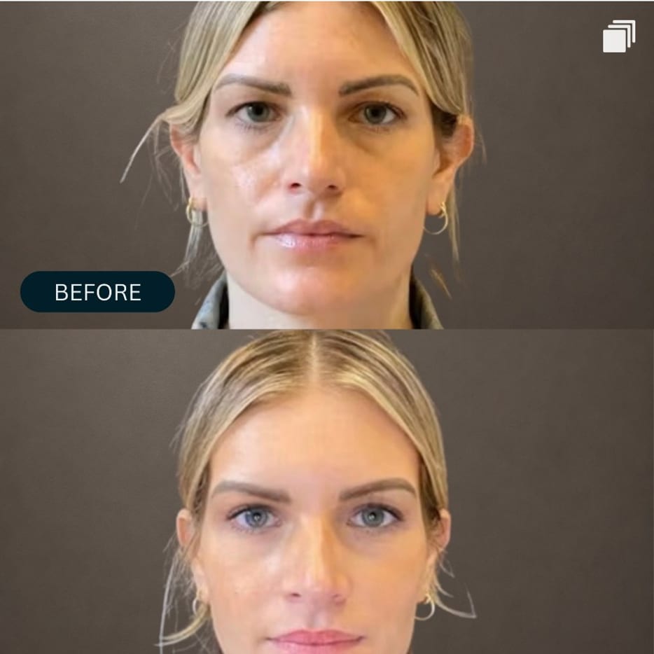Blepharoplasty is one of the most common