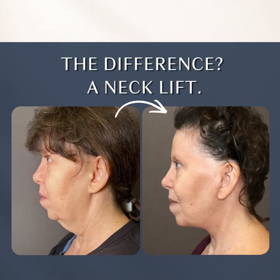 The difference a neck lift can make. 🤩