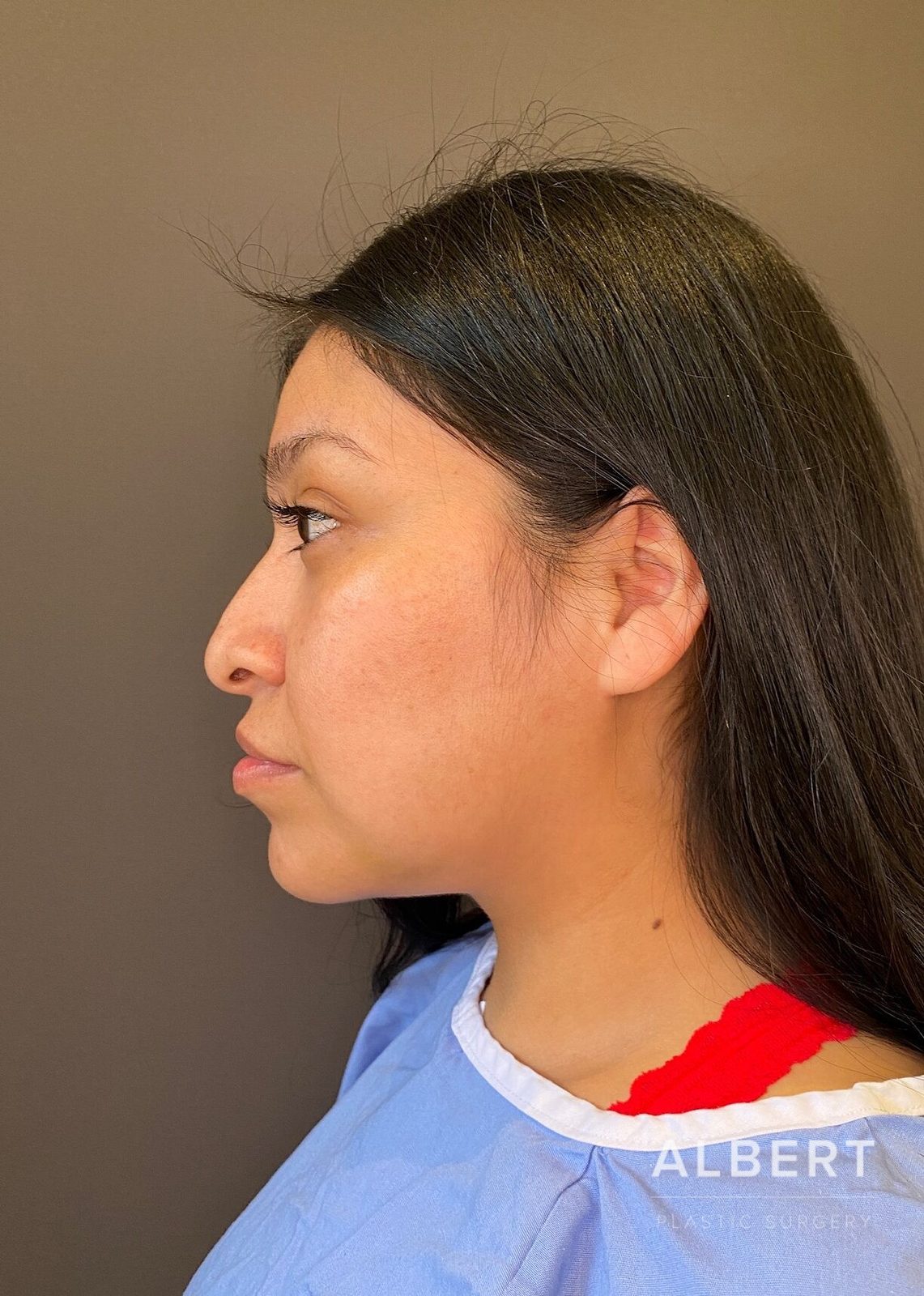 Rhinoplasty patient of Dr. Albert in NYC