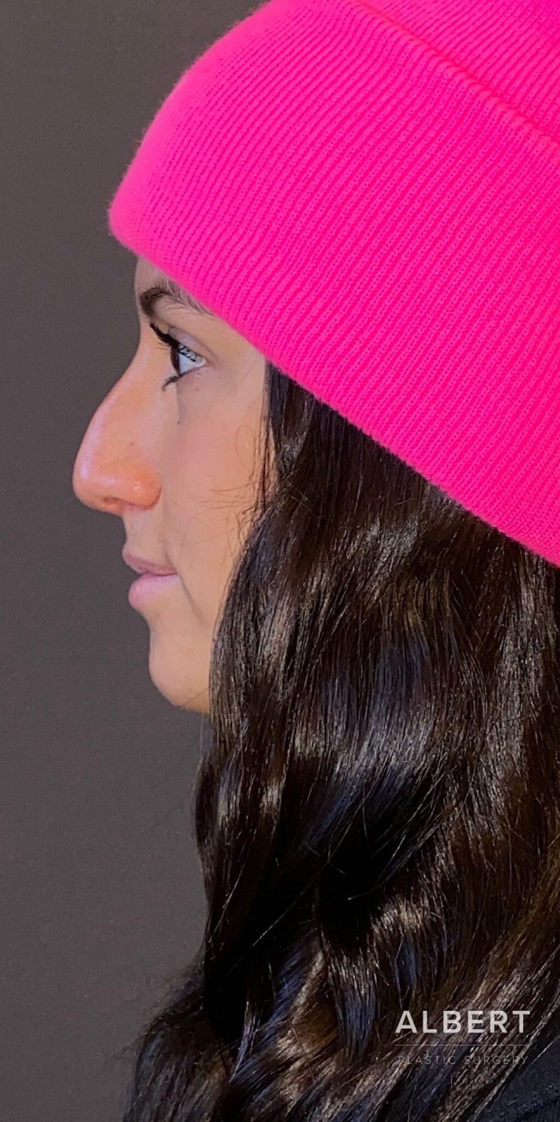 Rhinoplasty patient photo, first view