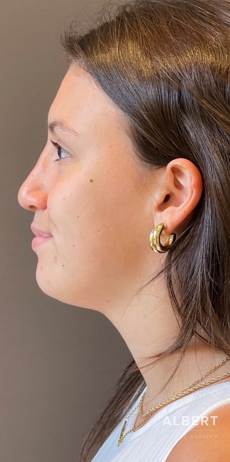 Rhinoplasty patient photo, second view