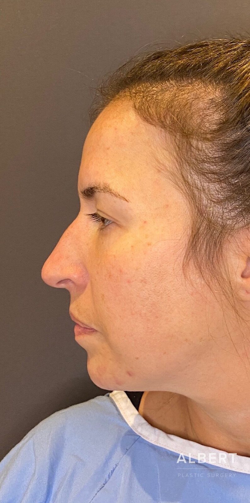 Rhinoplasty patient photo, first view