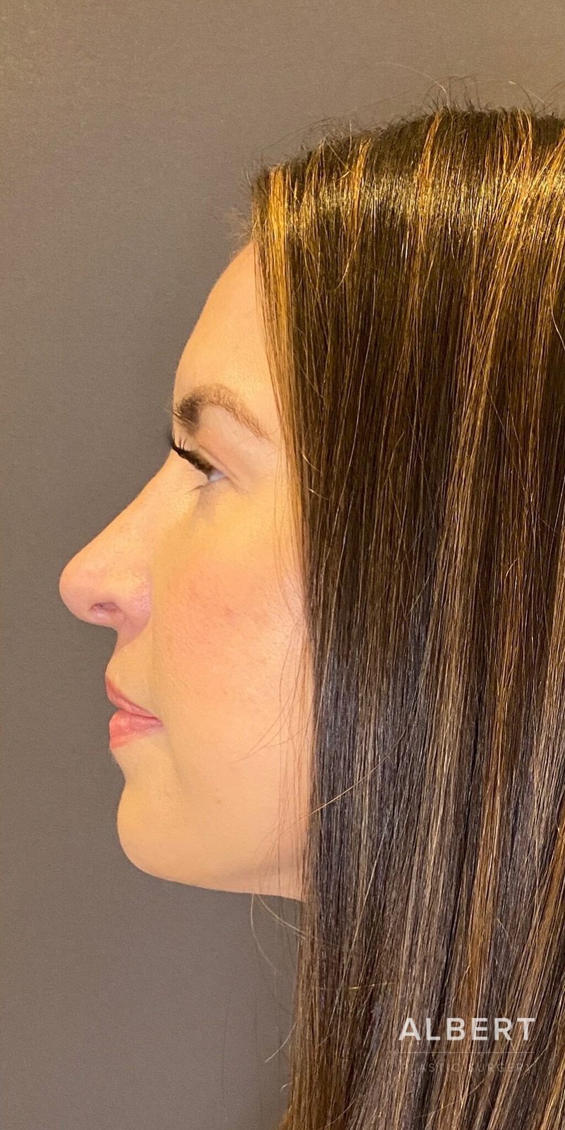 Rhinoplasty patient photo, second view