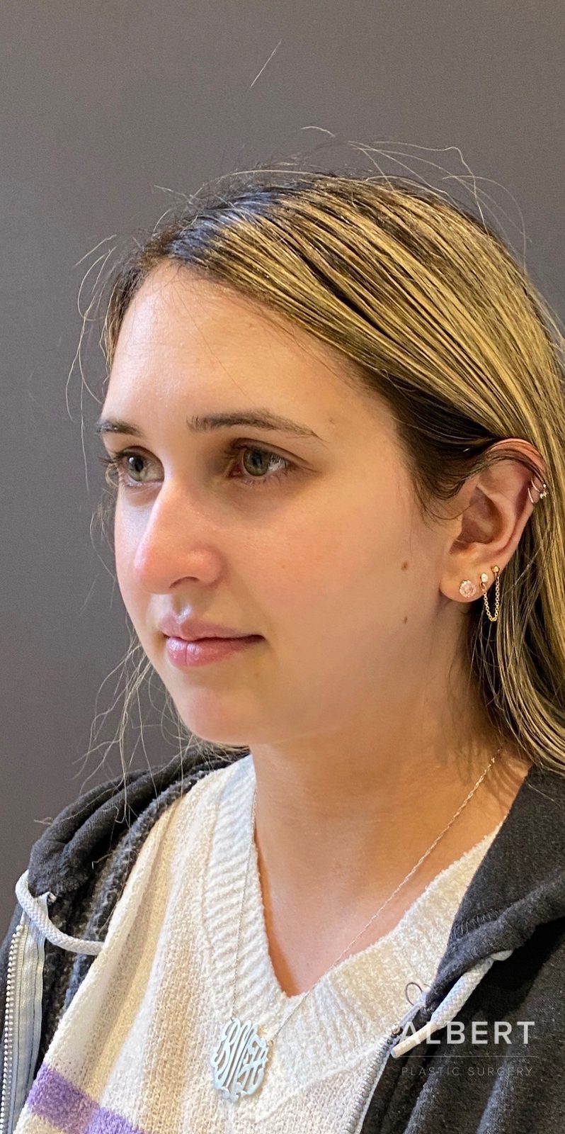 Rhinoplasty patient photo, first view