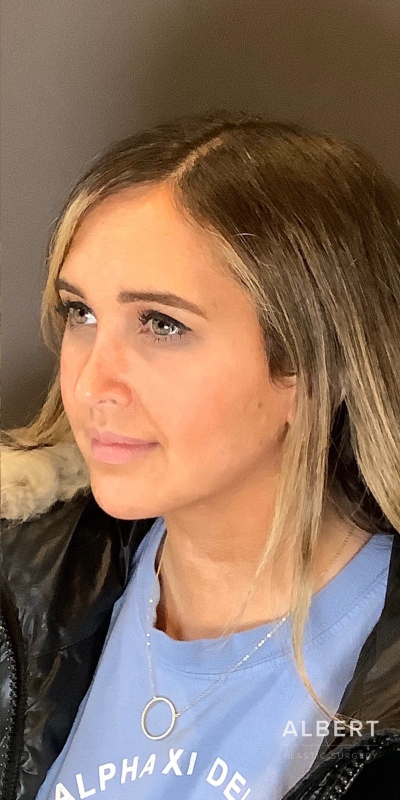 Rhinoplasty patient photo, second view