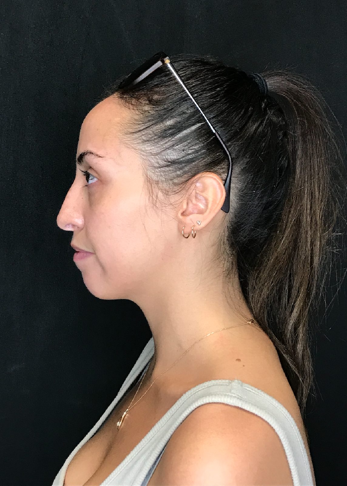 Rhinoplasty patient photo, first view