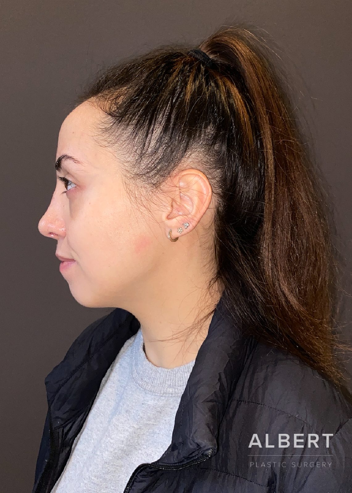 Rhinoplasty patient photo, second view