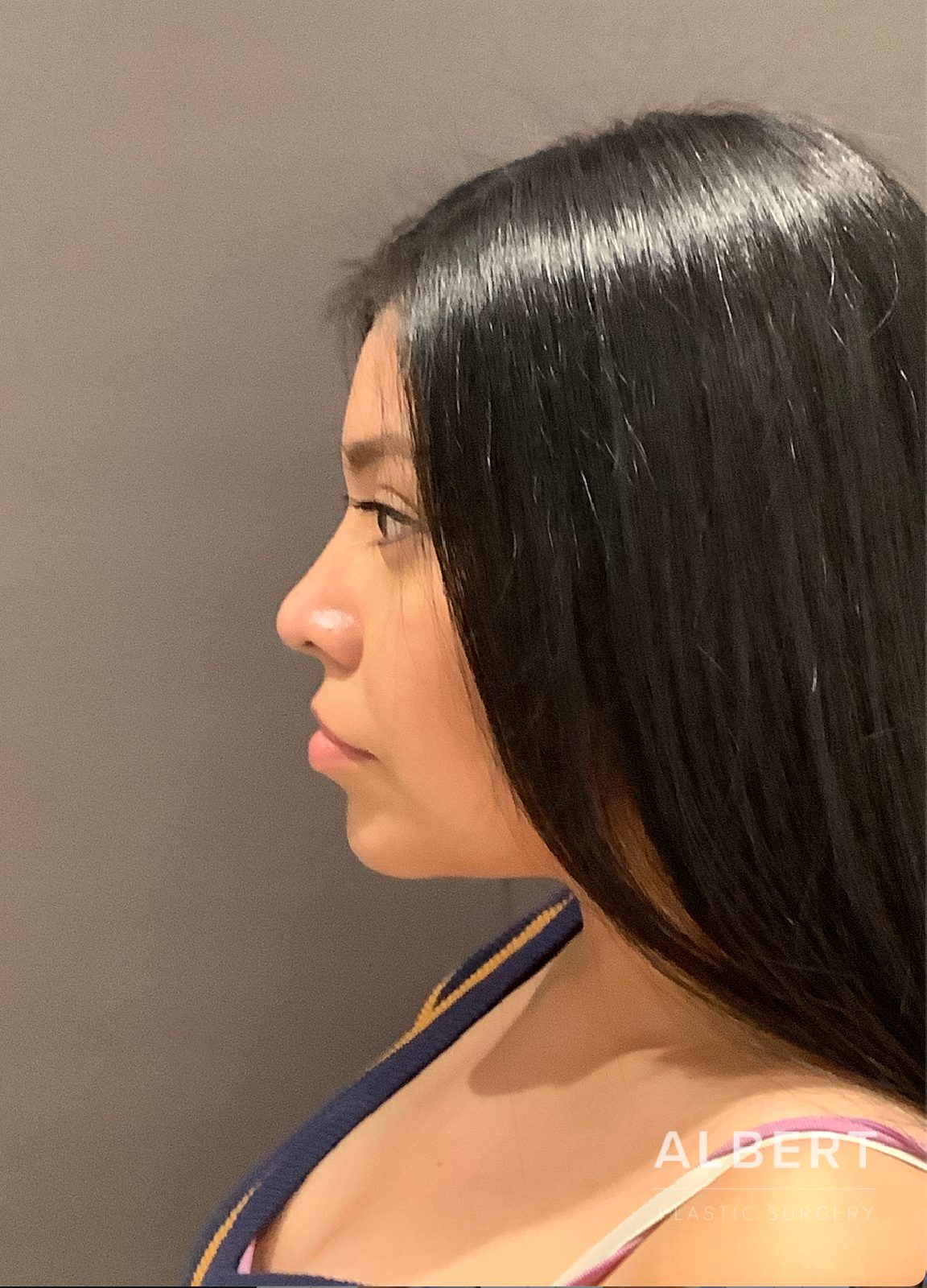 Rhinoplasty patient of Dr. Albert in NYC
