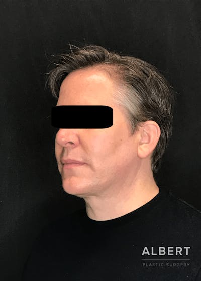 Liposuction Before & After Gallery - Patient 384585 - Image 2