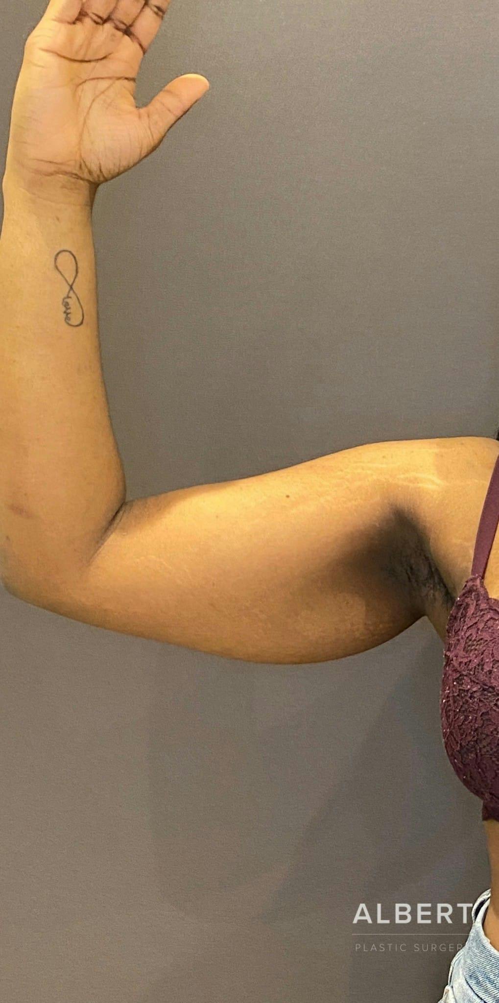 Liposuction Before & After Gallery - Patient 151452144 - Image 3