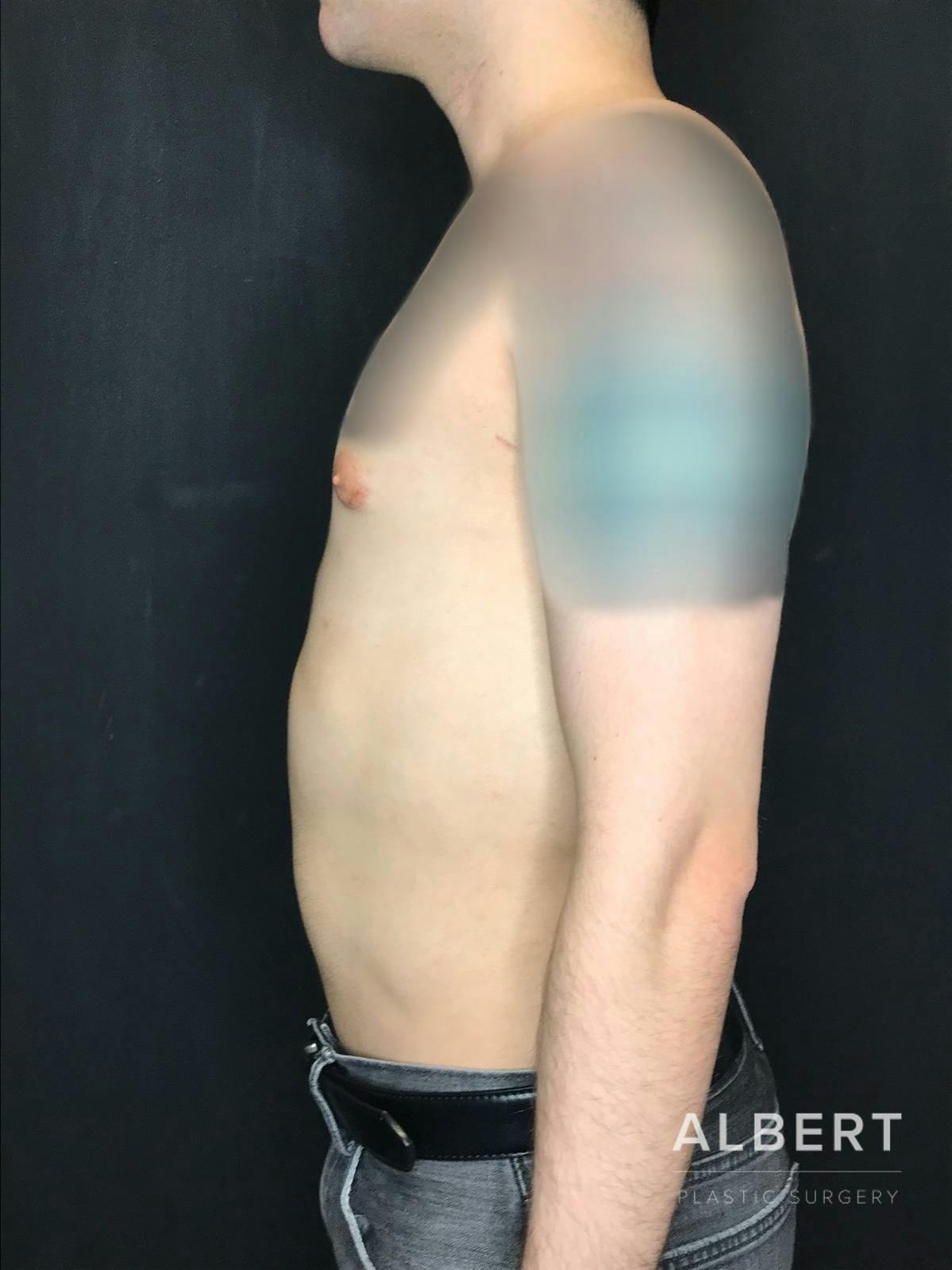 Liposuction Before & After Gallery - Patient 151452151 - Image 10