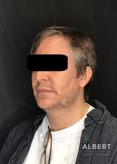 Liposuction Before & After Gallery - Patient 384585 - Image 1