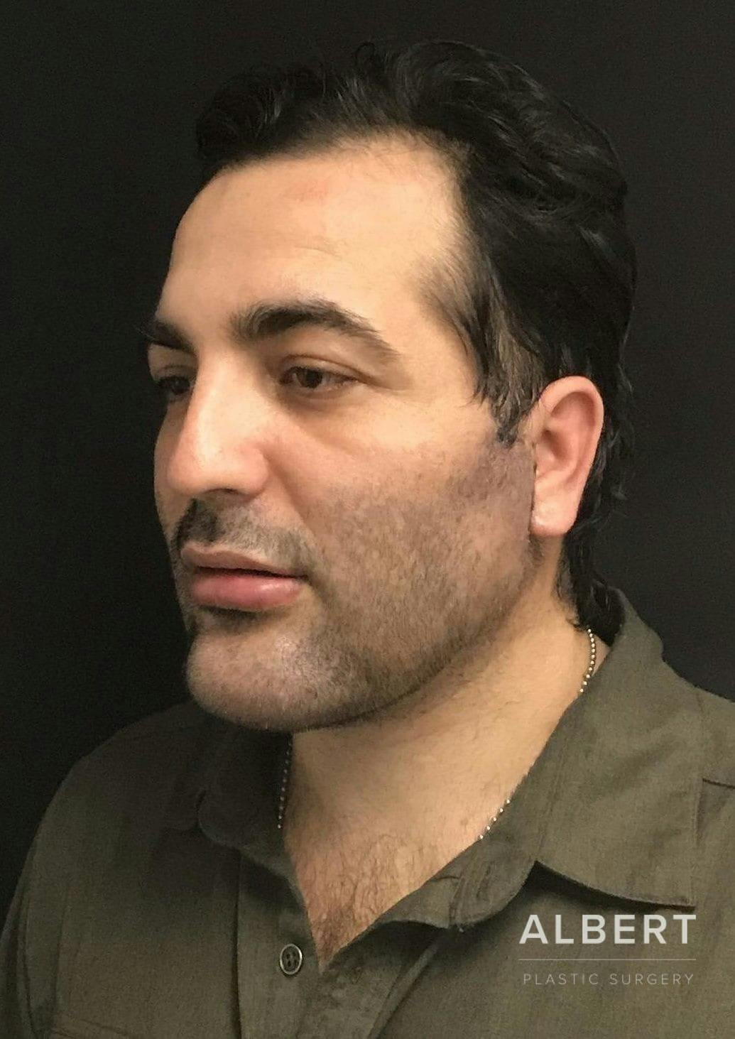 Facial Implants Before & After Gallery - Patient 151452121 - Image 2