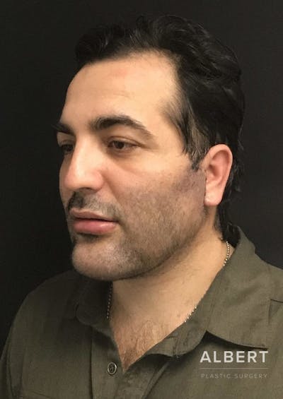 Facial Implants Before & After Gallery - Patient 151452121 - Image 2