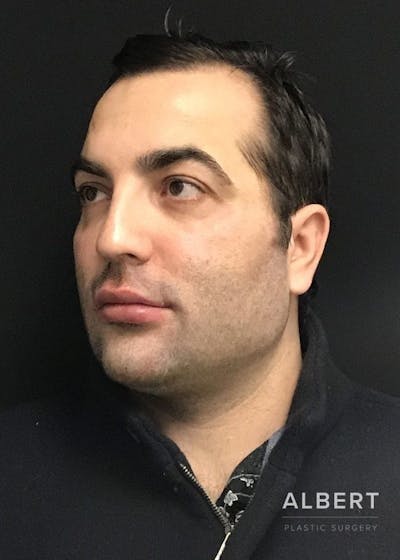 Facial Implants Before & After Gallery - Patient 151452121 - Image 1