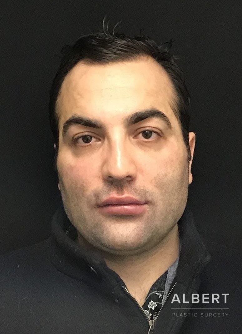 Facial Implants Before & After Gallery - Patient 151452121 - Image 3