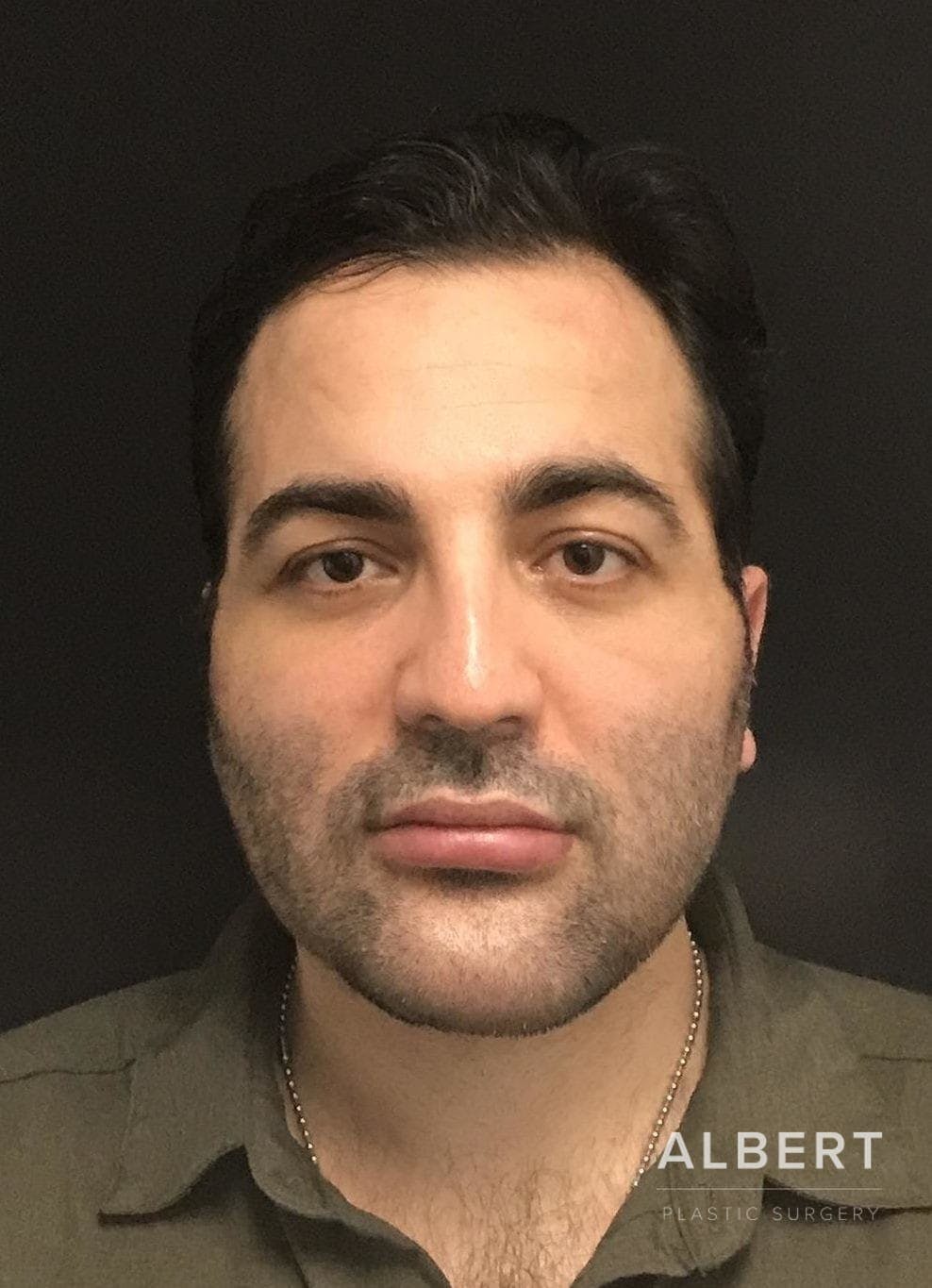 Facial Implants Before & After Gallery - Patient 151452121 - Image 4