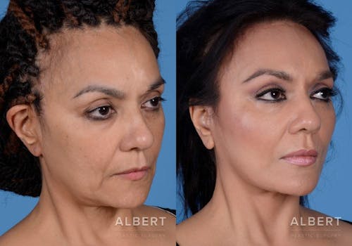 Neck Lift Procedure