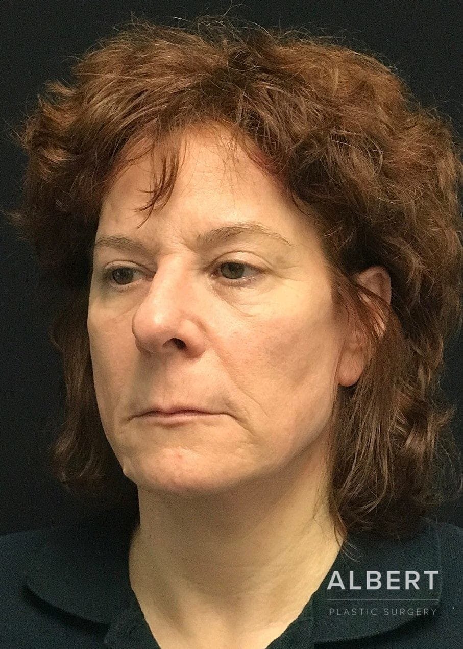 Lip Lift / Lip Reduction Before & After Gallery - Patient 151452138 - Image 3