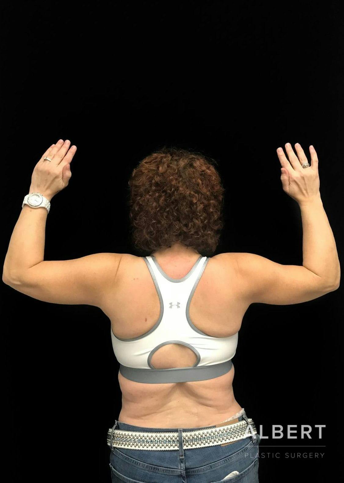 Brachioplasty Before & After Gallery - Patient 151362498 - Image 6