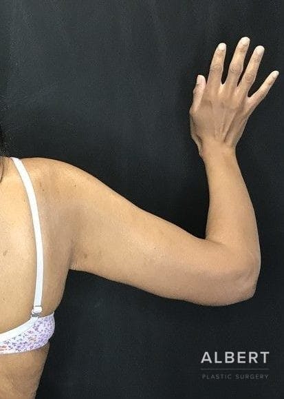 Brachioplasty Before & After Gallery - Patient 151351692 - Image 8