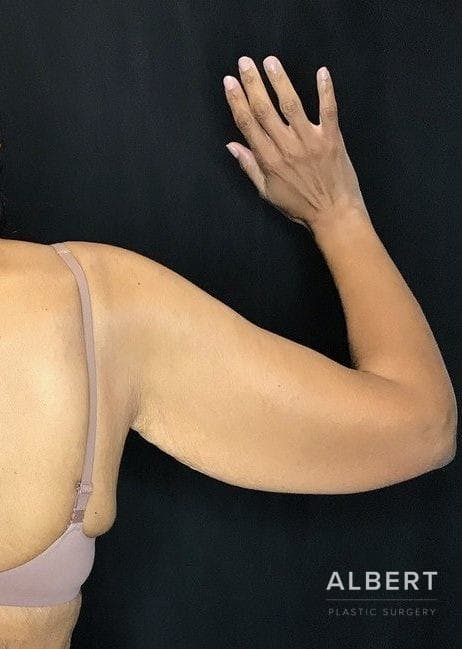 Brachioplasty Before & After Gallery - Patient 151351692 - Image 7