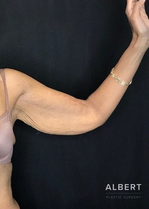 Brachioplasty Before & After Gallery - Patient 151351692 - Image 5