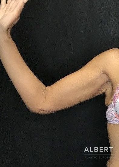 Brachioplasty Before & After Gallery - Patient 151351692 - Image 4