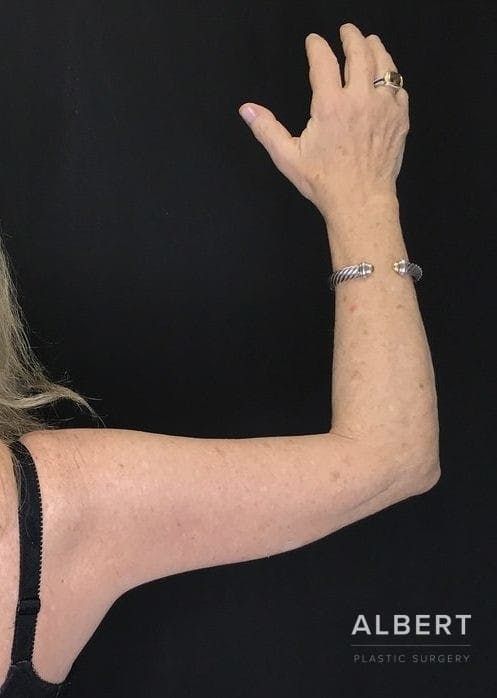 Brachioplasty Before & After Gallery - Patient 151351695 - Image 4
