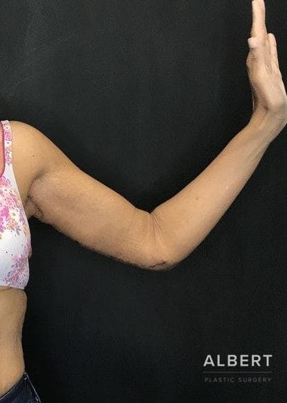 Brachioplasty Before & After Gallery - Patient 151351692 - Image 6