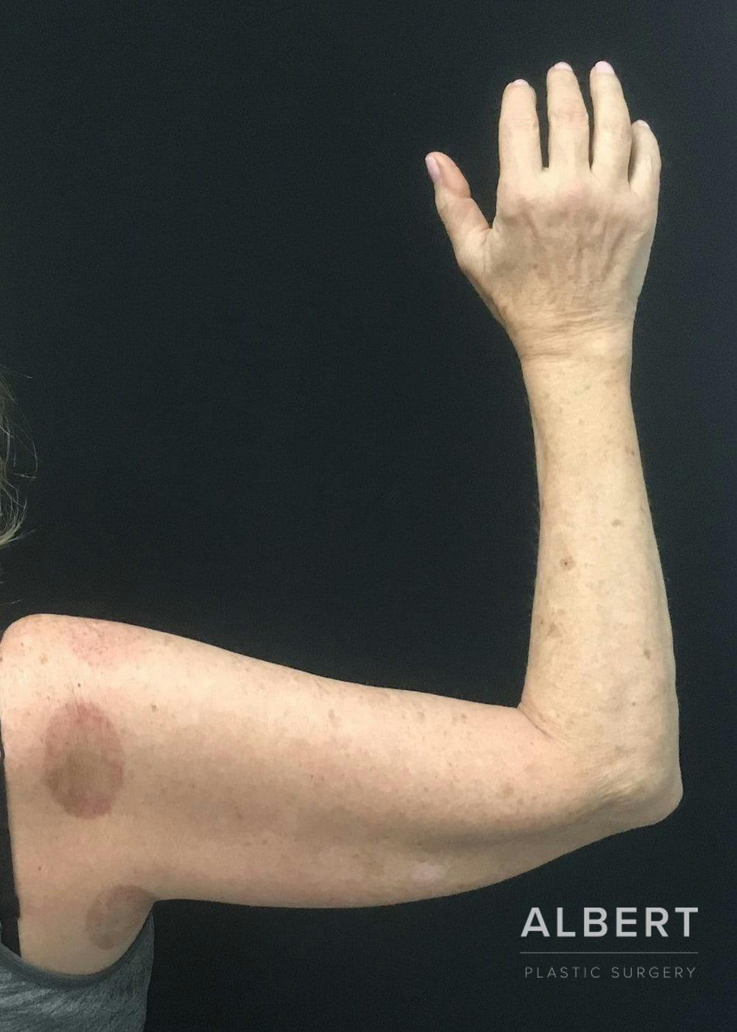 Brachioplasty Before & After Gallery - Patient 151351695 - Image 3