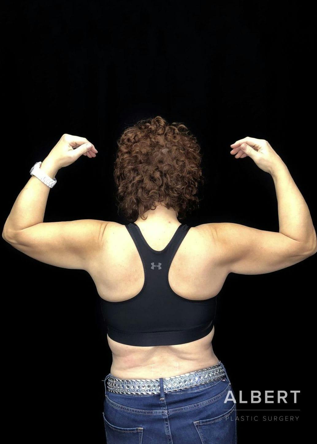 Brachioplasty Before & After Gallery - Patient 151362498 - Image 5