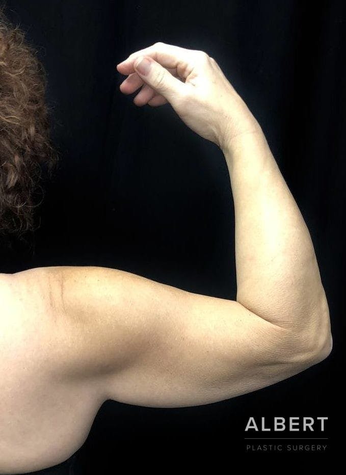 Brachioplasty Before & After Gallery - Patient 151362498 - Image 3