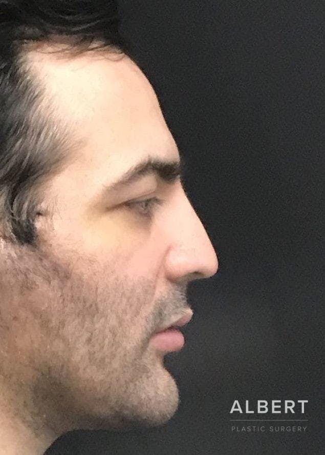 Facial Implants Before & After Gallery - Patient 151452121 - Image 6