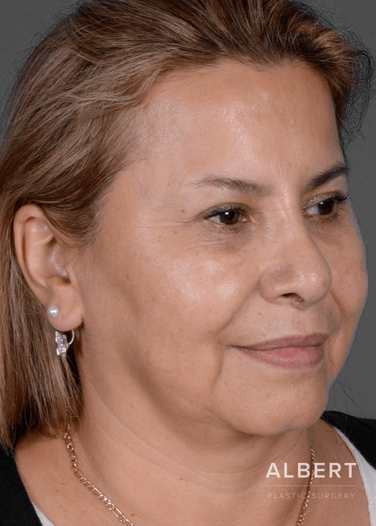 Rhinoplasty Before & After Gallery - Patient 151510784 - Image 4