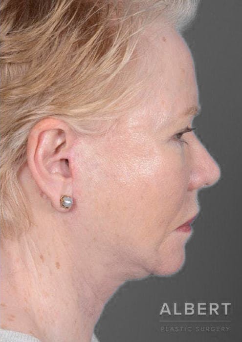 Facelifts / Necklift Before & After Gallery - Patient 151452105 - Image 4