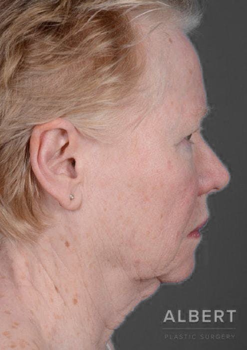 Facelifts / Necklift Before & After Gallery - Patient 151452105 - Image 3