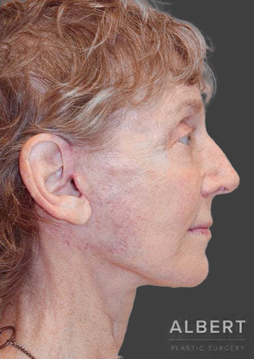 Facelifts / Necklift Before & After Gallery - Patient 151452111 - Image 4