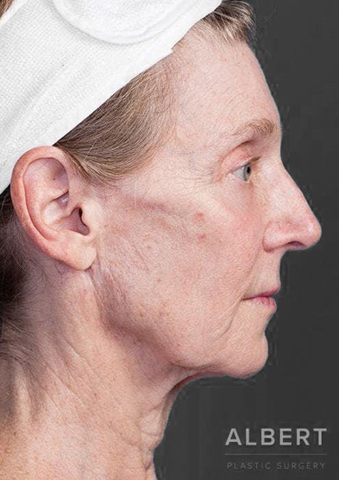 Facelifts / Necklift Before & After Gallery - Patient 151452111 - Image 3