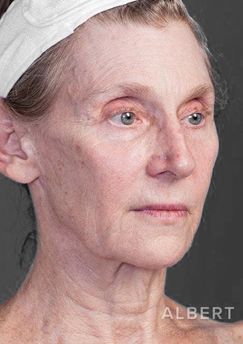 Facelifts / Necklift Before & After Gallery - Patient 151452111 - Image 1