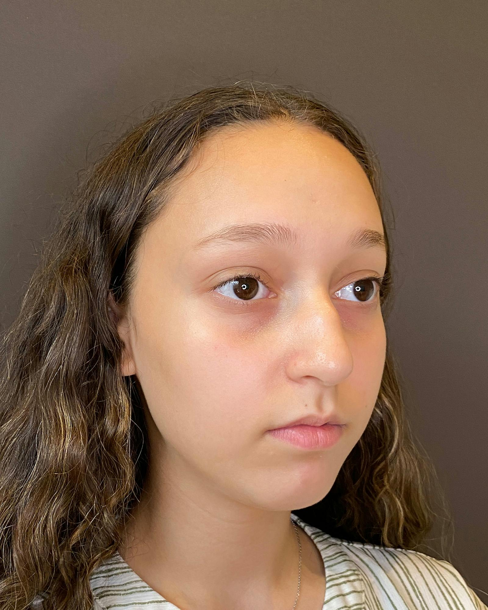 Rhinoplasty Before & After Gallery - Patient 151510781 - Image 3