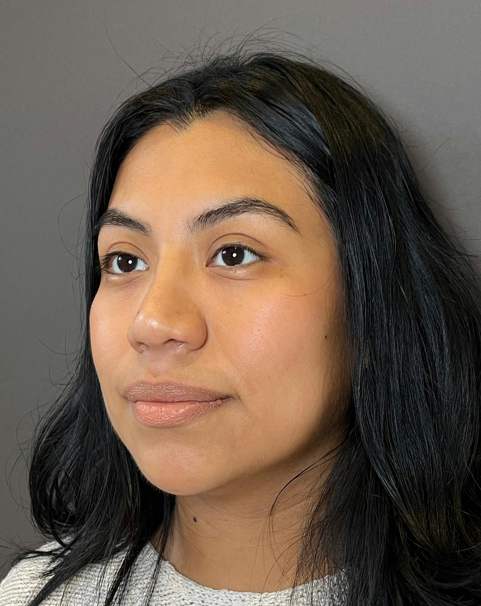 Rhinoplasty Before & After Gallery - Patient 151521035 - Image 8