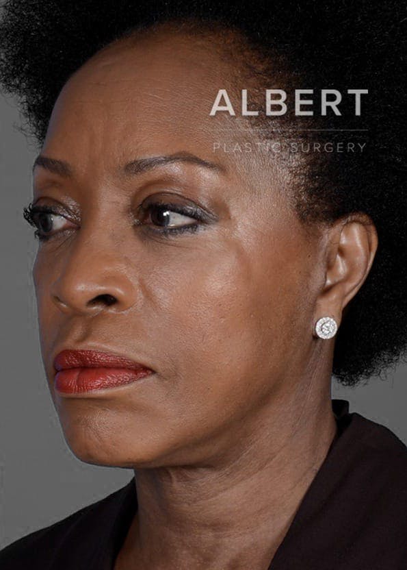 Chin Augmentation Before & After Gallery - Patient 151362562 - Image 6
