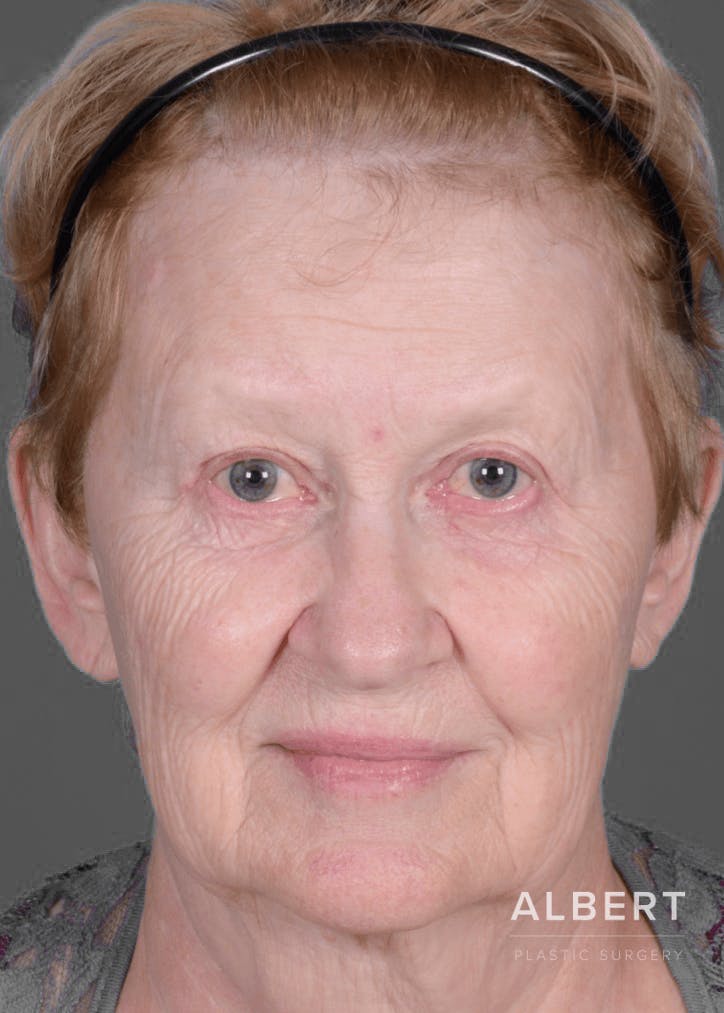 Eyelid Surgery Before & After Gallery - Patient 151362566 - Image 2
