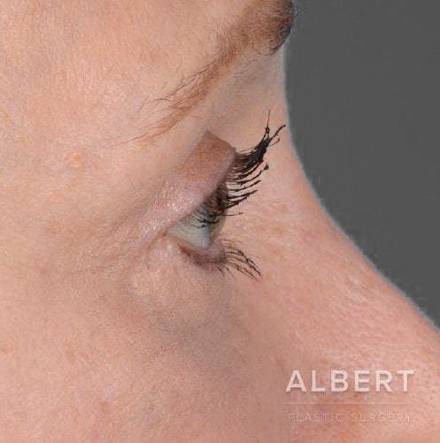 Eyelid Surgery Before & After Gallery - Patient 151398571 - Image 4