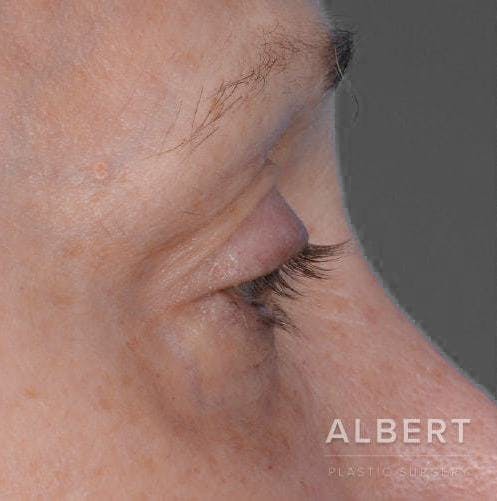 Eyelid Surgery Before & After Gallery - Patient 151398571 - Image 3